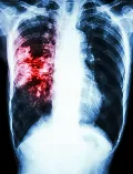 Study shows who should take preventive treatment for TB